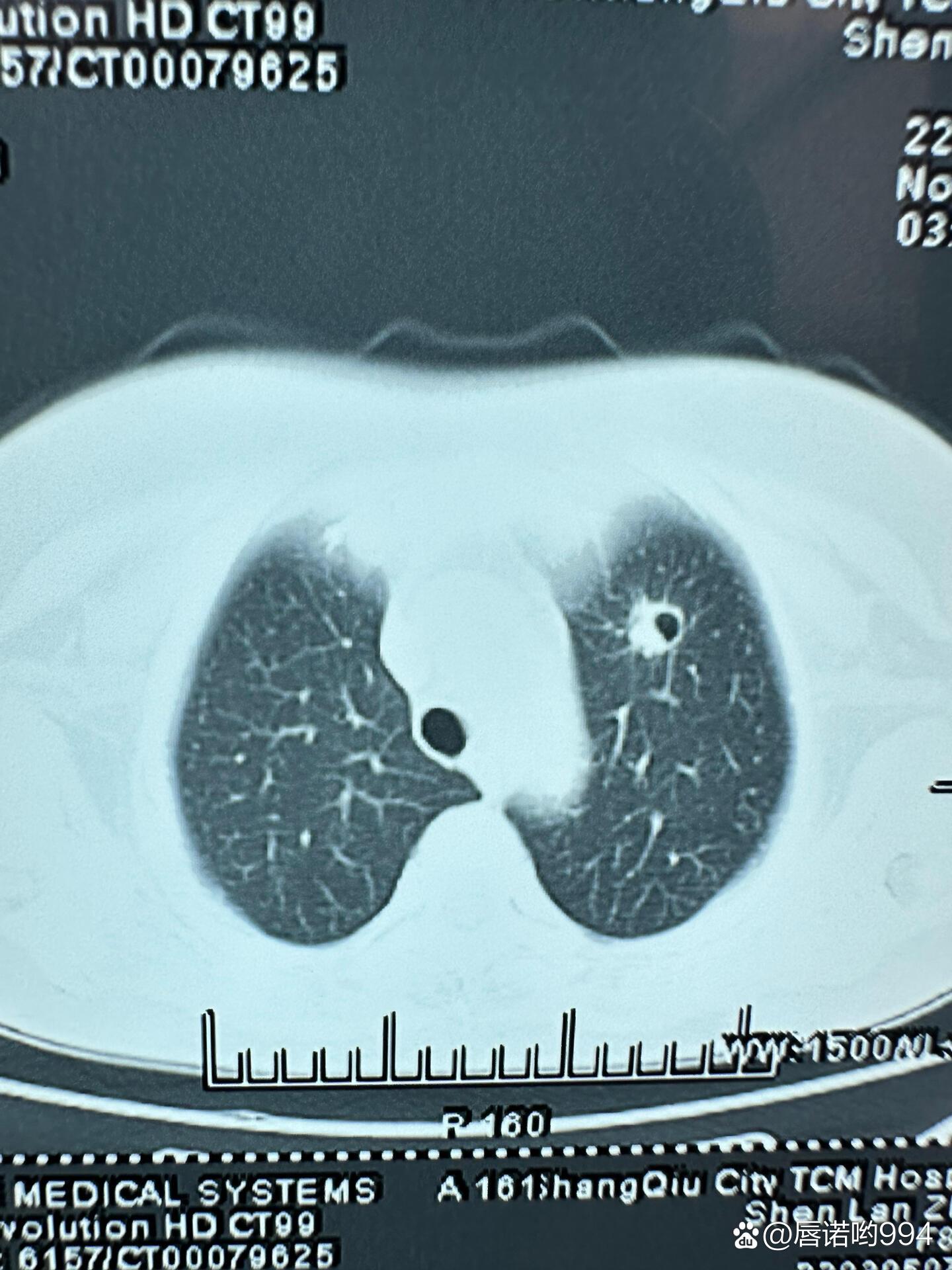 上海已开始二次感染-上海确诊第二例肺炎-第2张图片